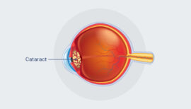 Cataract Diagram