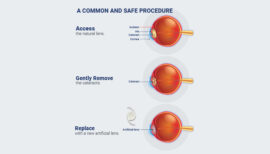 Cataract Surgery Chart Inserting an IOL