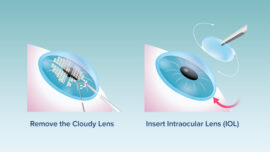 Cataract Surgery Chart Inserting an IOL
