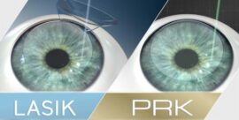 LASIK and PRK chart