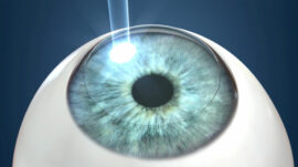PRK Laser Eye Surgery Diagram