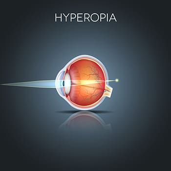 Diagram showing example of Hyperopia