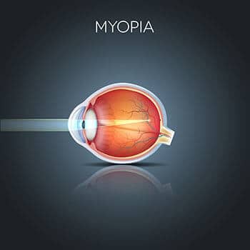 Diagram with example of Myopia