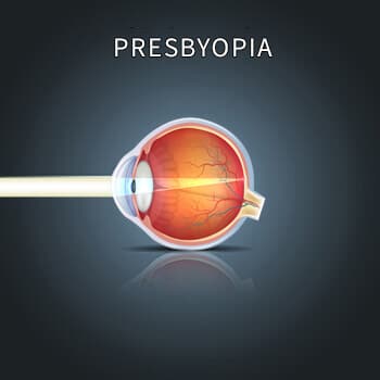 Diagram showing example of Presbyopia